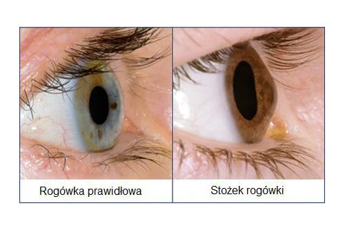 Porównanie prawidłowej rogówki do rogówki ze stożkiem.